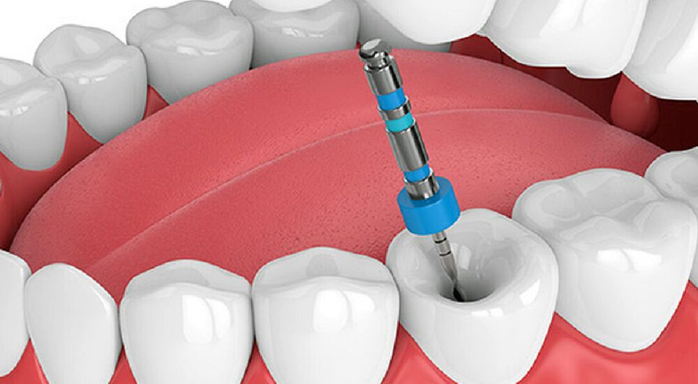 Dental-House_0000s_0001_Endodoncia