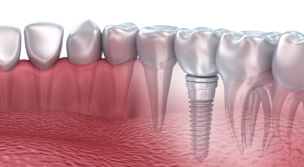 Dental-House_0000s_0002_Implantologia oral