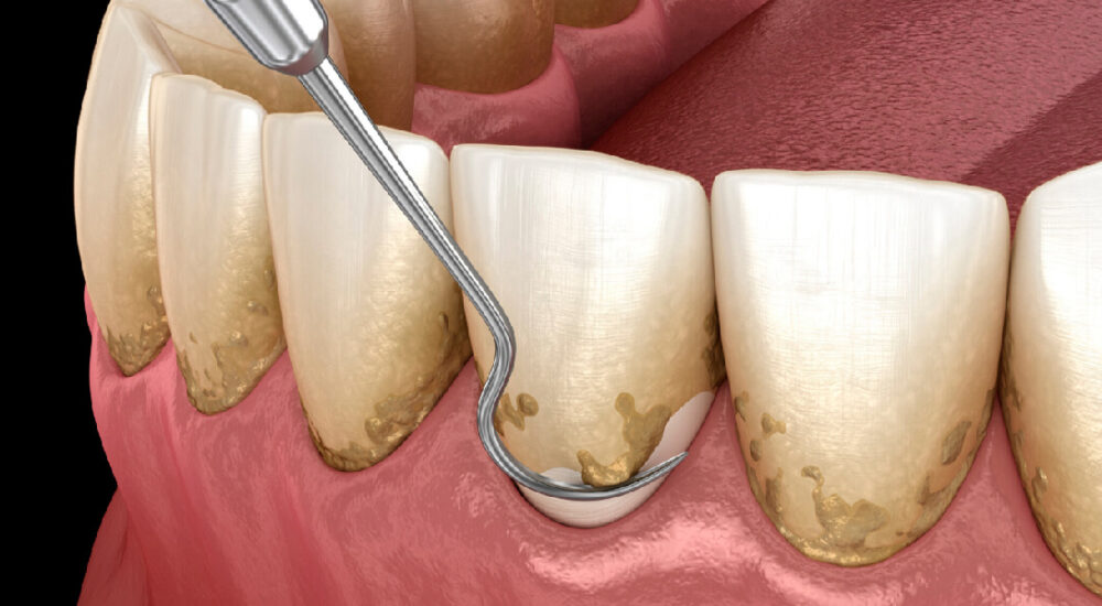 Dental-House_0000s_0004_Periodoncia